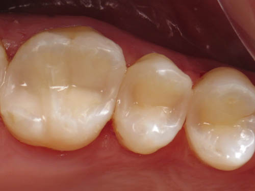 Dental-bonding-after-372787